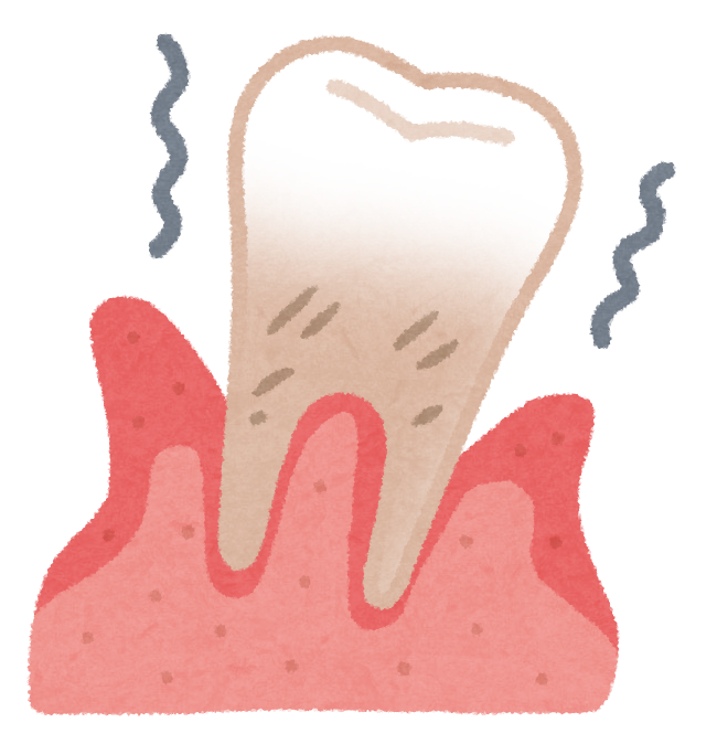 歯周病の症状
