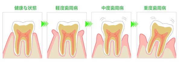 歯周病